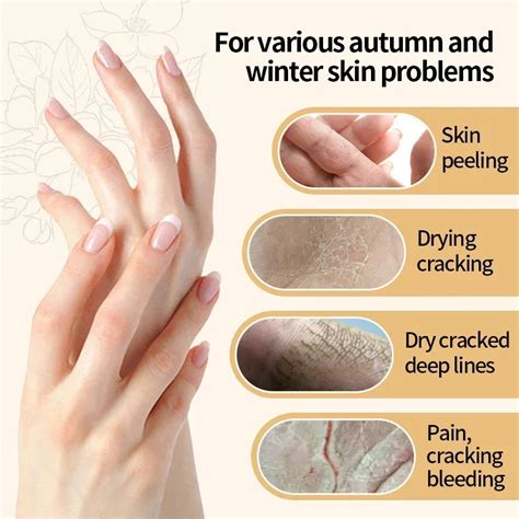 Advanced Dry Cracked Hand Cream – Borkut