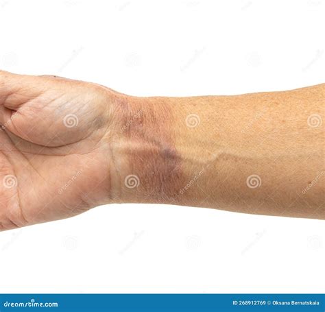 Hot Water Burn on the Skin of the Hand Stock Image - Image of heat