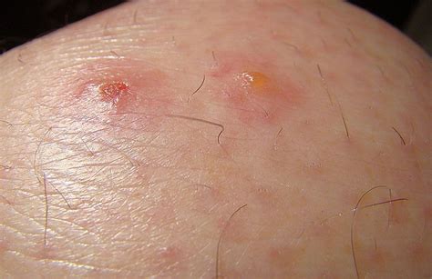 Chigger Bites Vs Flea Bites - What Are The Differences?