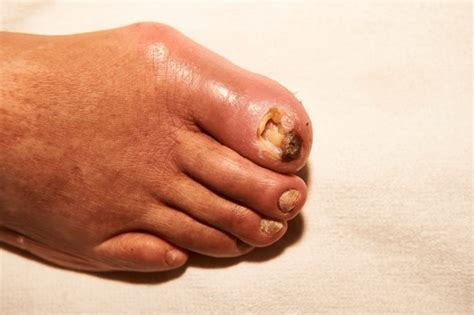 1+ Hundred Diabetic Foot Necrosis Royalty-Free Images, Stock Photos ...
