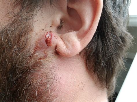 Popping Cysts