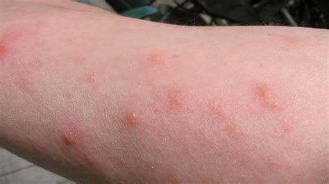 Poison ivy rash: Fact About Rash Symptoms & Treatment