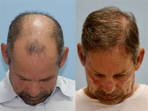 5,000 FUE Hair Graft Hair Surgery - Carolina Hair Surgery