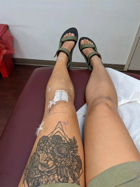 Post-op day 3: ACL reconstruction (patellar tendon graft) and lateral