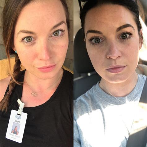 Before (left) sun damaged, uneven and dull skin tone. After (right