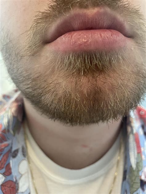 Dry Patch of skin on lower lip : r/DermatologyQuestions