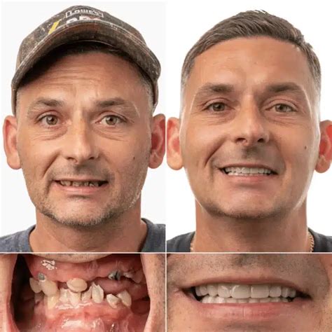 All-on-4 Dental Implants in Jacksonville, FL | Free Consultation