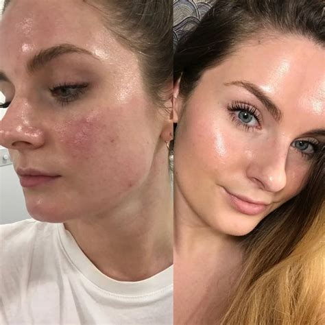 How to Treat Broken Capillaries on the Face | PS Beauty