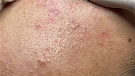Relaxing Acne Treatment #157(Linh My Dang) - YouTube