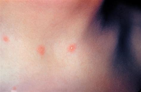 Treating Severe Chickenpox