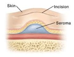 Treating a Post-Surgical Seroma or Hematoma - Sanara MedTech
