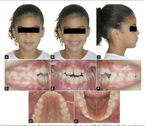 Figure 1 from Rapid Palatal Expansion and Utilization of E-space in ...