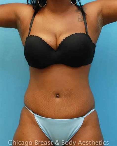 tummy tuck cost chicago breast body