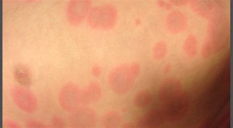 'Erythema Multiforme' | Nursing Times