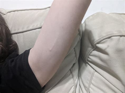 Is it normal for an implant to be COMPLETELY visible from the outside