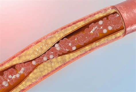 Polycaprolactone: Spearheading Innovation in Drug Delivery Systems ...