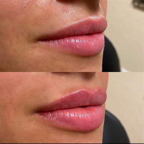 Lip filler before and after | Beautiful, natural | @OVMEofficial on IG! | Lip fillers, Lips ...