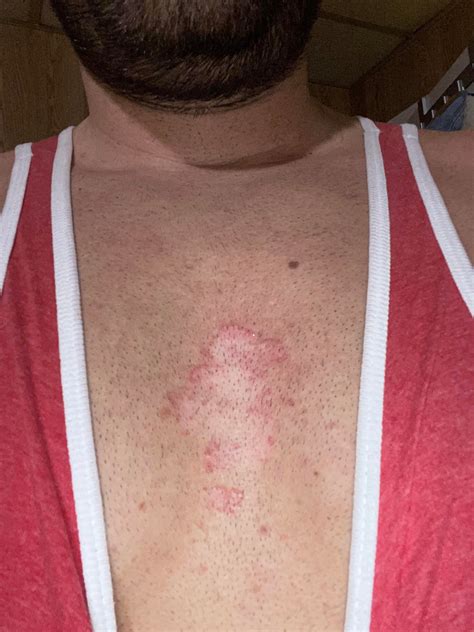 itchy chest  red bumps  ideas rdermatologyquestions