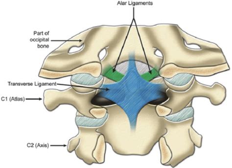 Comorbidity Burden Associated With Poor Outcomes in Atlantoaxial Fusion ...