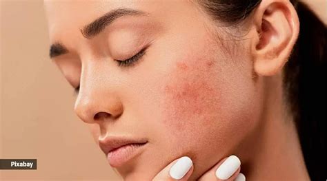 Skin Care Tips: Heat pimples are causing spots on the skin, these home remedies will provide ...