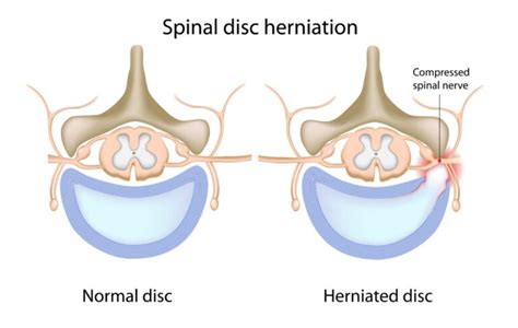 Sciatica and Herniated Discs • Roots