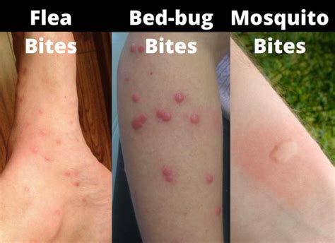 Bed Bug Vs Flea Bites