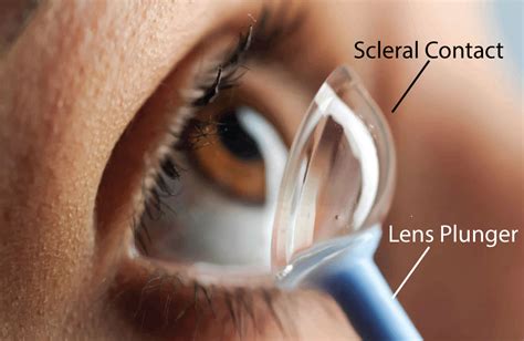 Scleral Contact Lenses | Contacts Compare