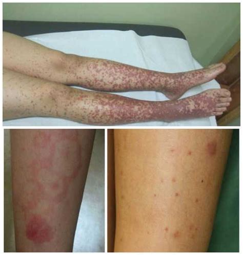henoch schonlein purpura hsp idiseasescom