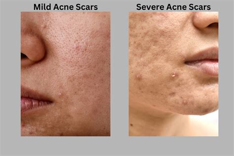 Very Mild Acne Scars