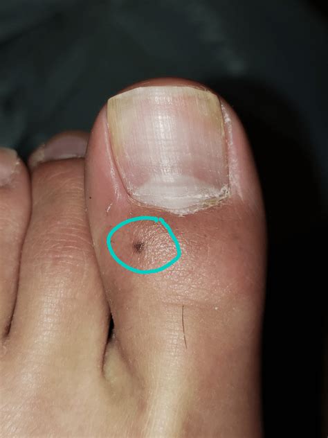just noticed this mole on my toe. is this melanoma?? : r/Dermatology