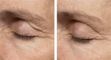 thermage treatments   eye area dr michele green md