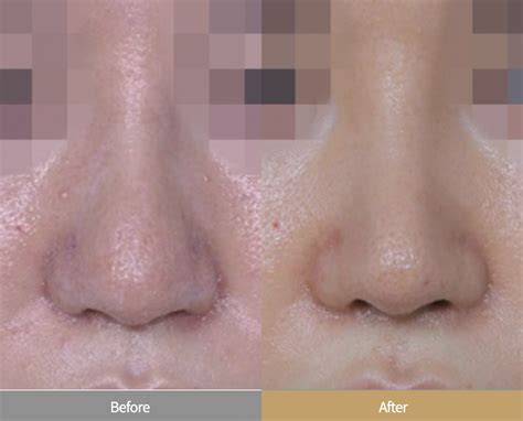 bulbous nose correction