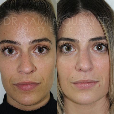 Alar Base Reduction | Face MD