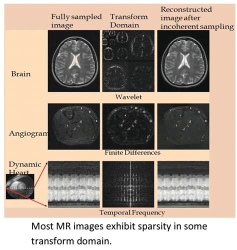 Compressed Sensing for Rapid MRI: Need for Speed | | LATEST BIOMEDICAL ENGINEERING UPDATES,JOBS ...