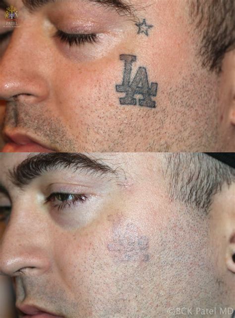 Transepidermal Elimination Tattoos