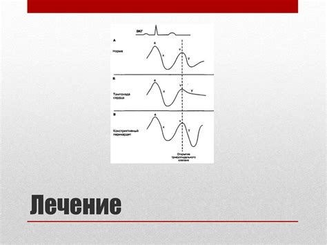 Тампонада сердца. Первая помощь. Алгоритмы диагностики и лечения ...