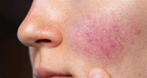 Common Symptoms of Rosacea - ActiveBeat