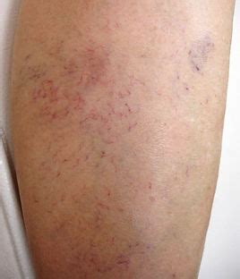 Types of varicose vein | cvsclinic | venous disease classification