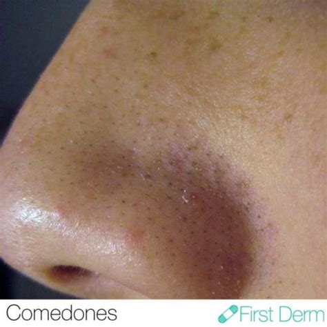 Sebum Plugs: Everything You Need To Know