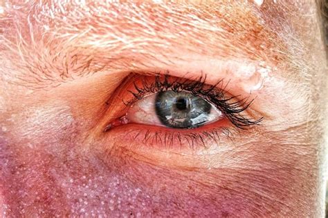 Can UV Exposure Cause Eye Cancer? - The Eye News