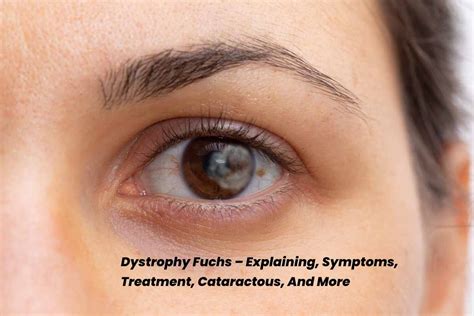 dystrophy fuchs explaining symptoms treatment cataracts