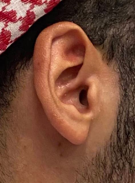 Resolution of ear erythema most notable in ear fossa triangularis and ...