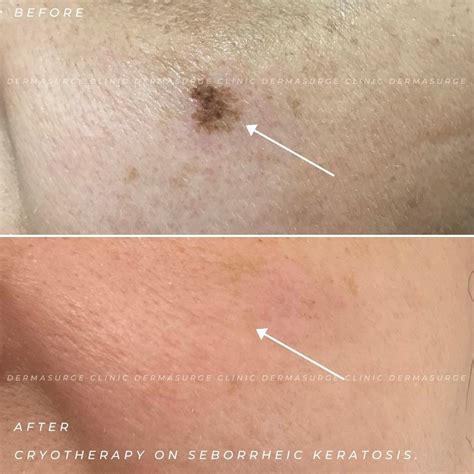 cryotherapy dermasurge clinic