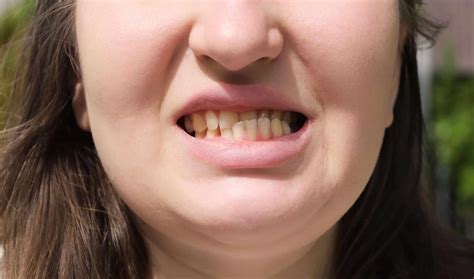 Uneven Bite? Signs of Jaw Misalignment You Shouldn’t Ignore