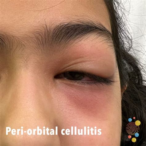 Preseptal Cellulitis