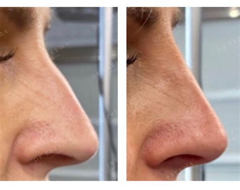 dermal fillers london dr preema london clinic