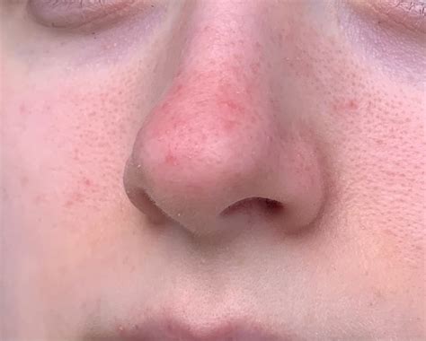 rosacea pls  dermatologists rosacea facial redness