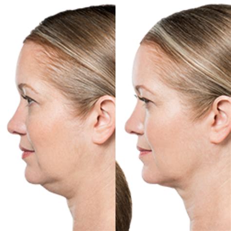 kybella houston    serendipity luxury wellness