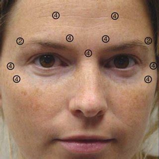 (PDF) Obagi, S. Correction of Surface Skin Deformities: Botox, Fillers