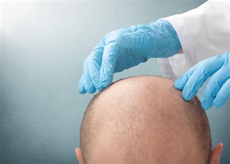 DHI (Direct Hair Implantation) - Hair Transplant In Turkey - Elit ...